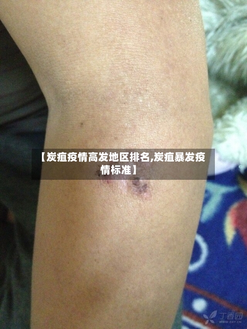 【炭疽疫情高发地区排名,炭疽暴发疫情标准】-第1张图片