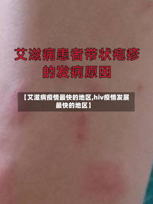 【艾滋病疫情最快的地区,hiv疫情发展最快的地区】-第3张图片